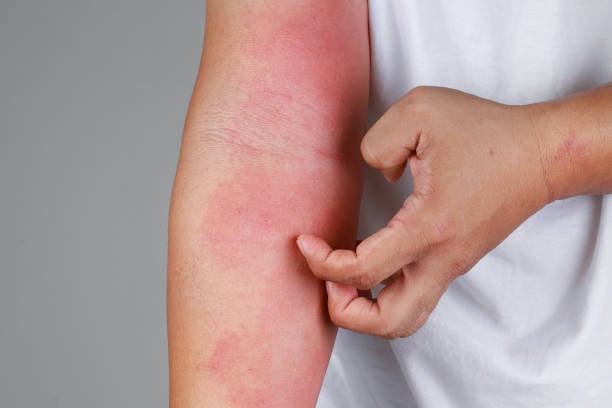 Expert Inflammation Treatment